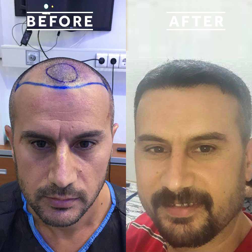 Hair Transplant Reviews - Hair Transplant In Turkey - Elit International  Clinic